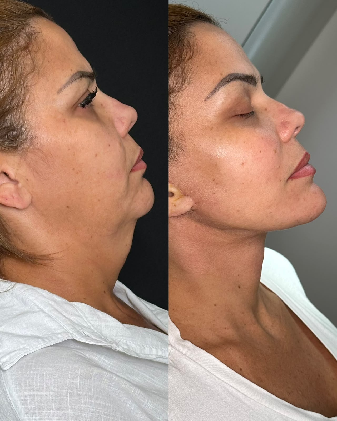 acabando-com-papada