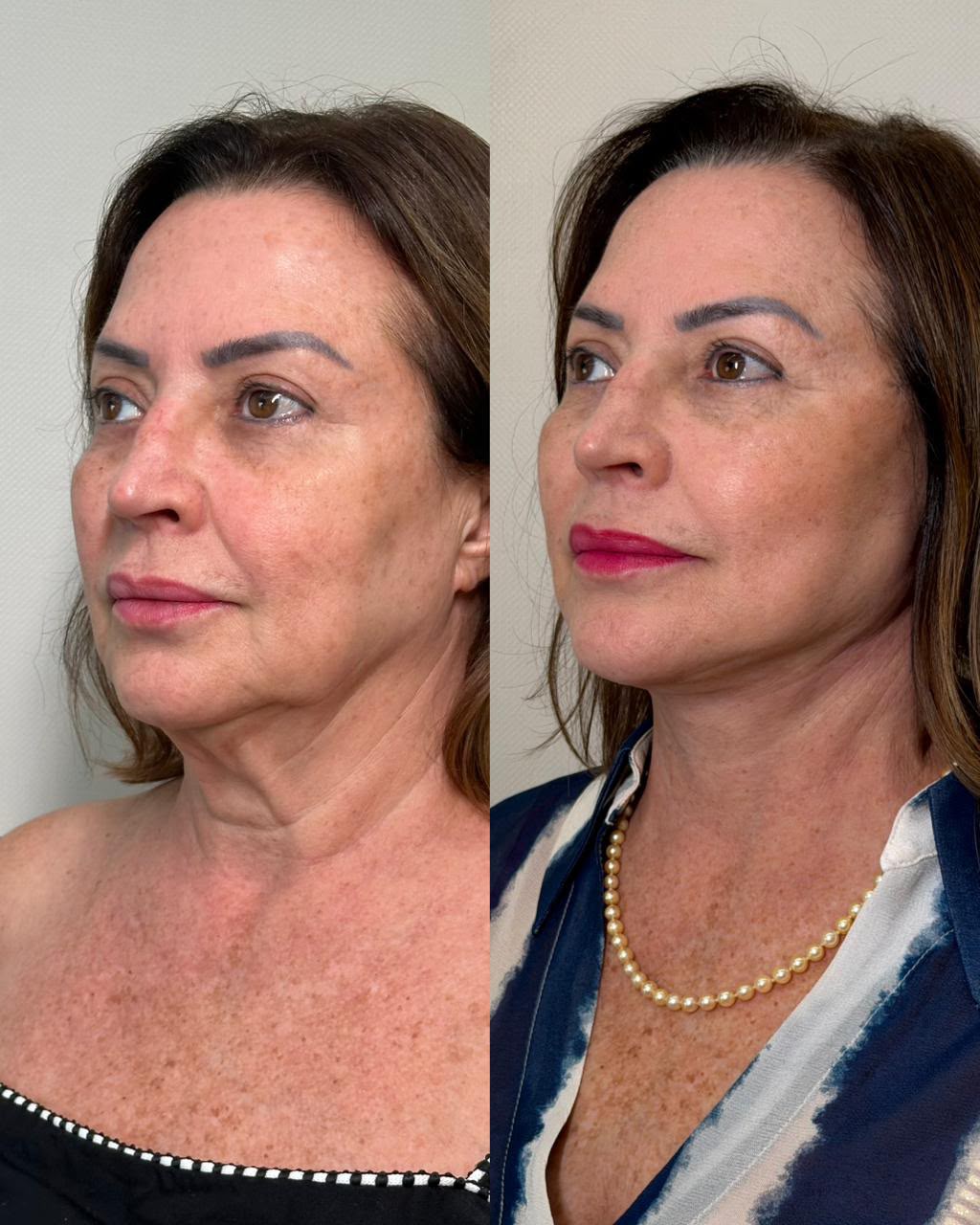 adeus-papada