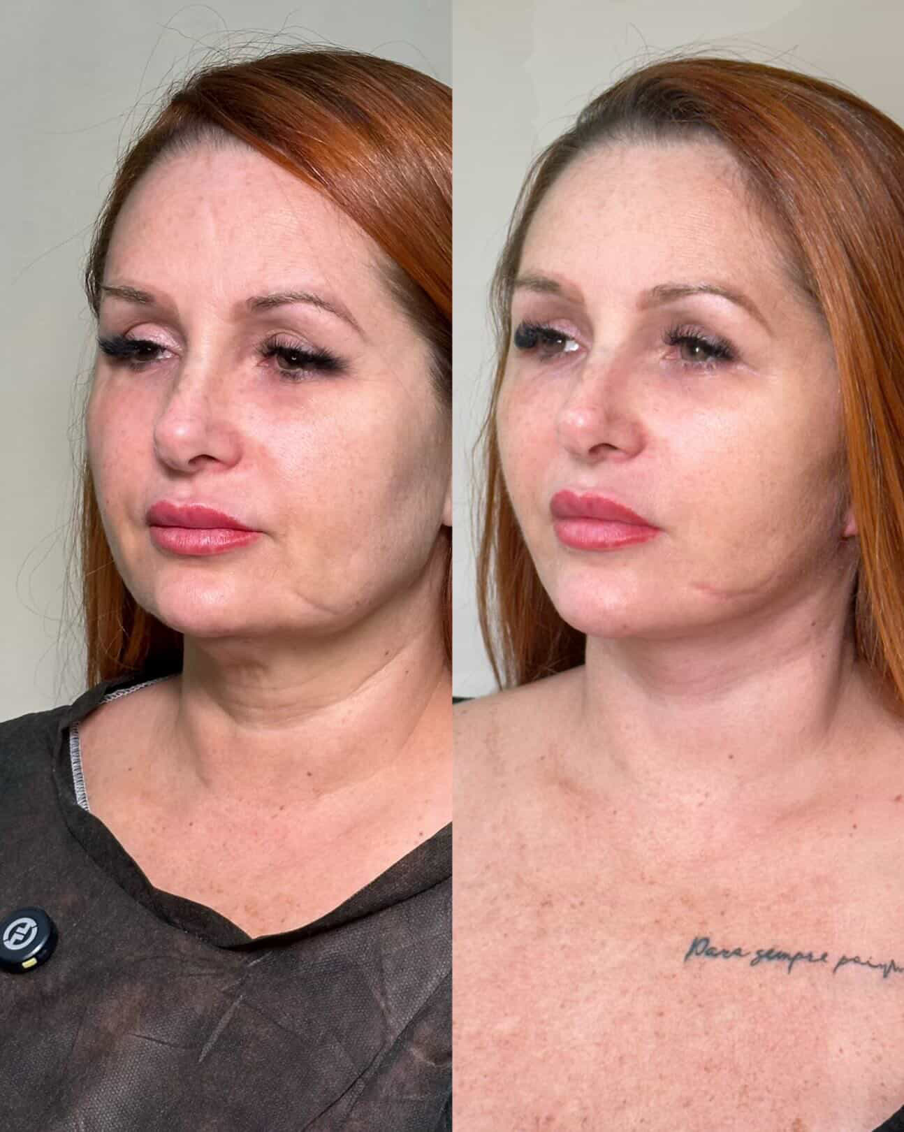 cirurgia de papada