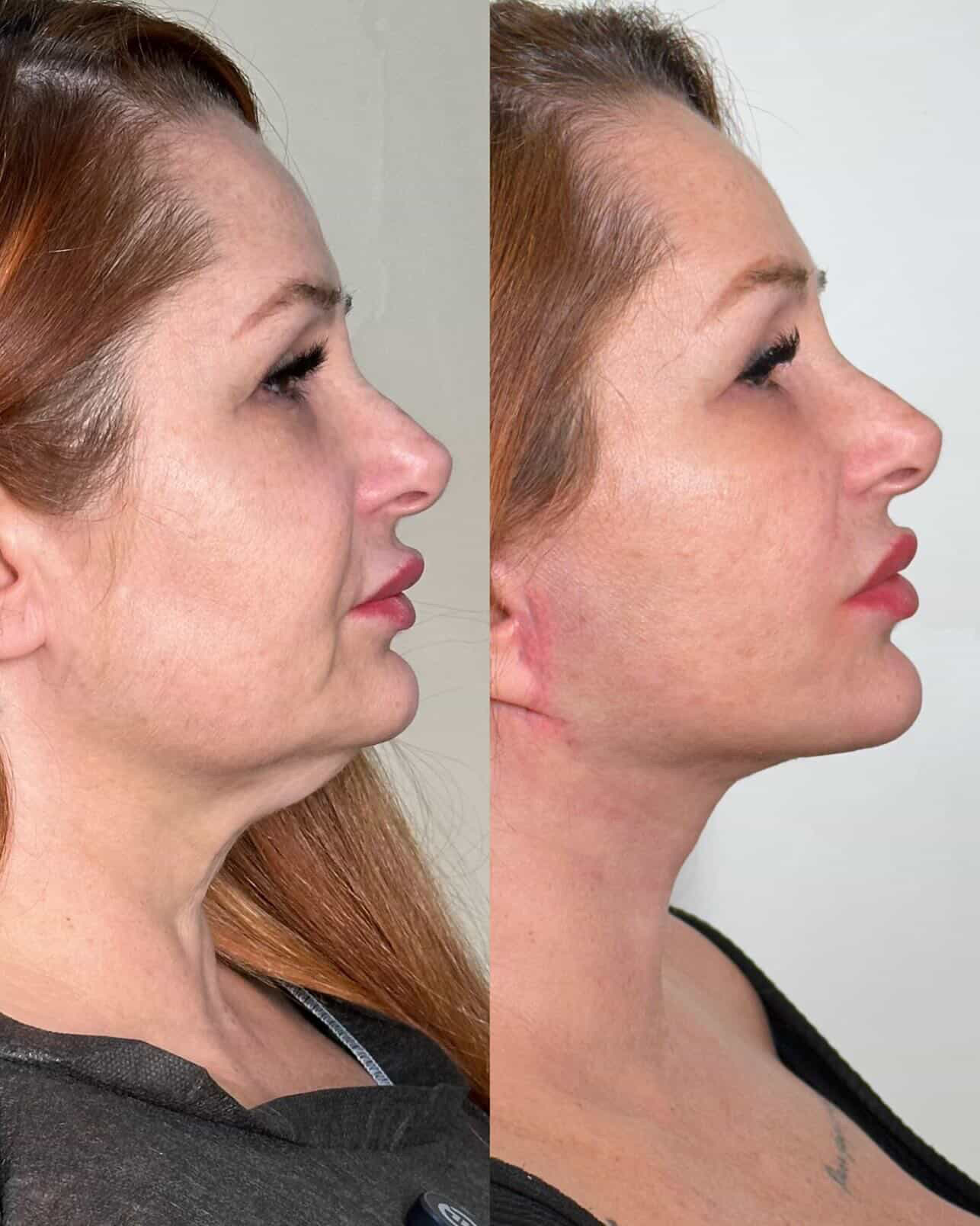 lipo de papada